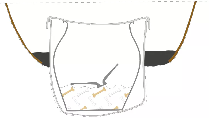 schéma représentant en coupe l'urne funéraire en plomb contenue dans un fond d'amphore et contenant elle-même un vase en céramique. A l'intérieur de ce vase en céramique, des restes humains et le couvercle du vase sont présents. 